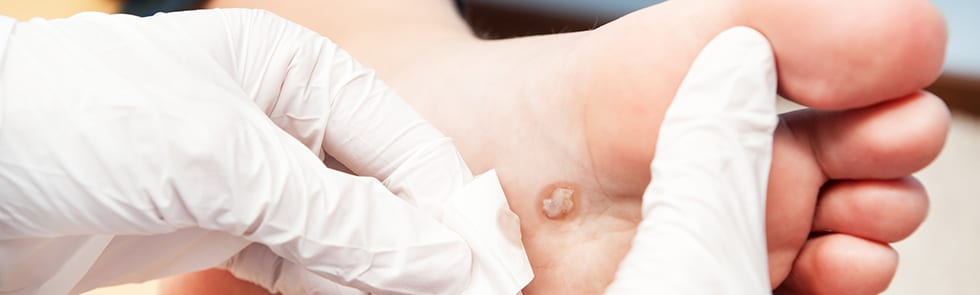Mole on a foot being treated by a doctor.