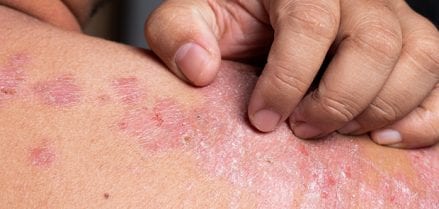 Psoriasis on skin being scratched.
