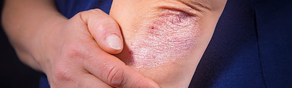 Psoriasis on person's elbow