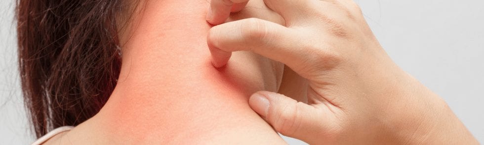person scratching summer heat rash on their neck