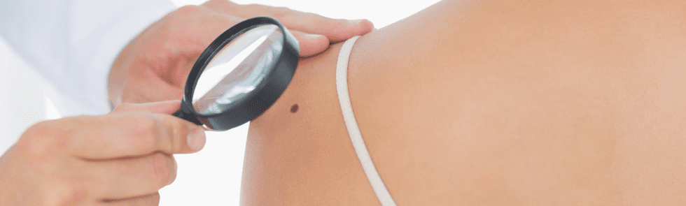 Doctor looking at mole on patient's shoulder with magnifying glass