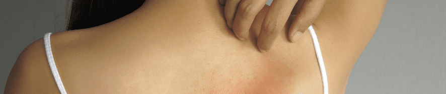 Woman scratching rash on her back