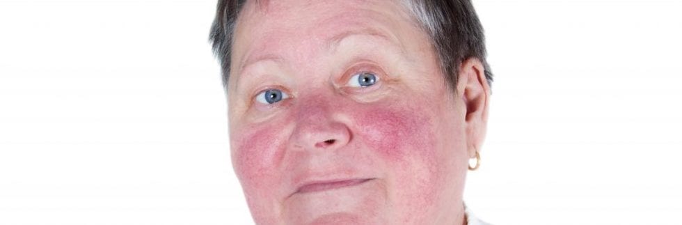 Person with rosacea on face
