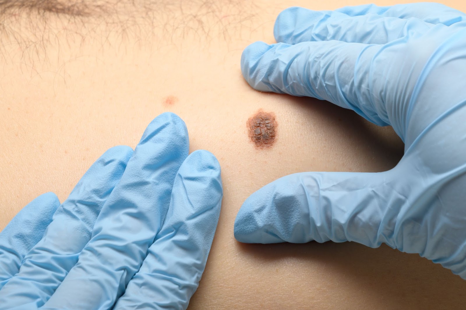 Close up of a doctor examining a mole on a patient
