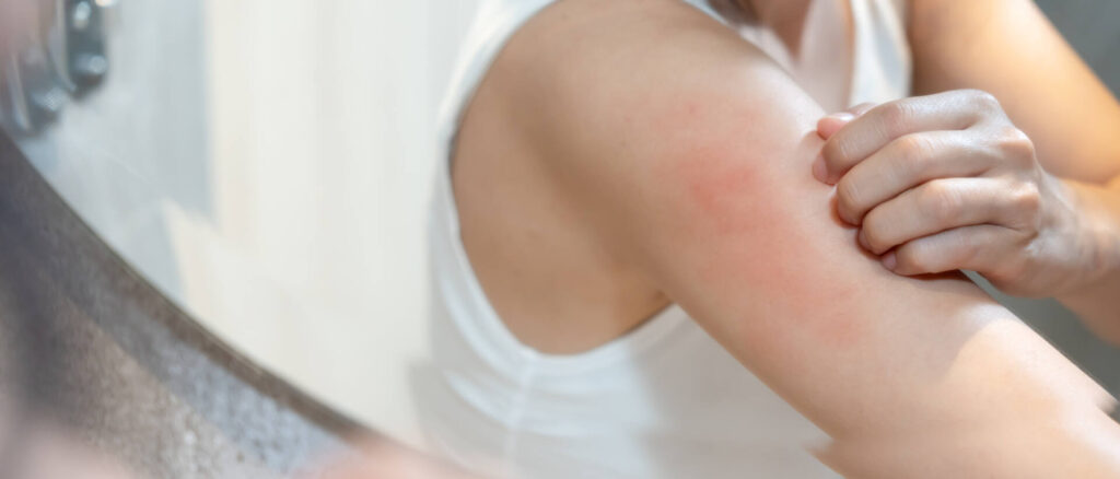 skin problem and beauty. woman scratch body has itchy skin from skin allergic, steroid allergy, sensitive skin, red from sunburn, chemical allergy, rash, insect bites, Seborrheic Dermatitis.