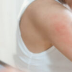 skin problem and beauty. woman scratch body has itchy skin from skin allergic, steroid allergy, sensitive skin, red from sunburn, chemical allergy, rash, insect bites, Seborrheic Dermatitis.
