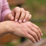 Woman scratching inflamed skin with eczema on hands