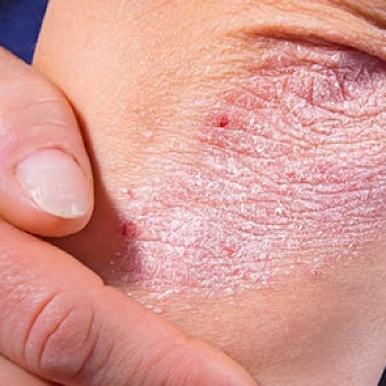 Psoriasis on person's elbow