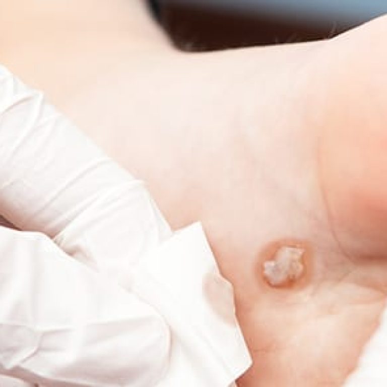 Doctor treating wart on the bottom of patient's foot