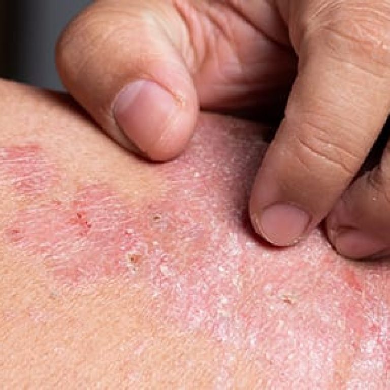 Person scratching rash on their back