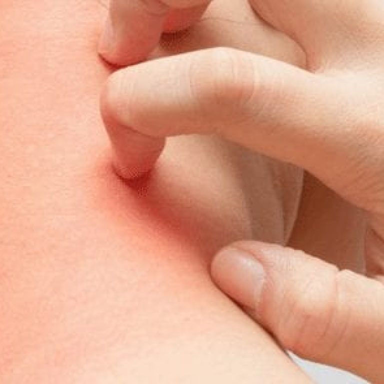 person scratching summer heat rash on their neck