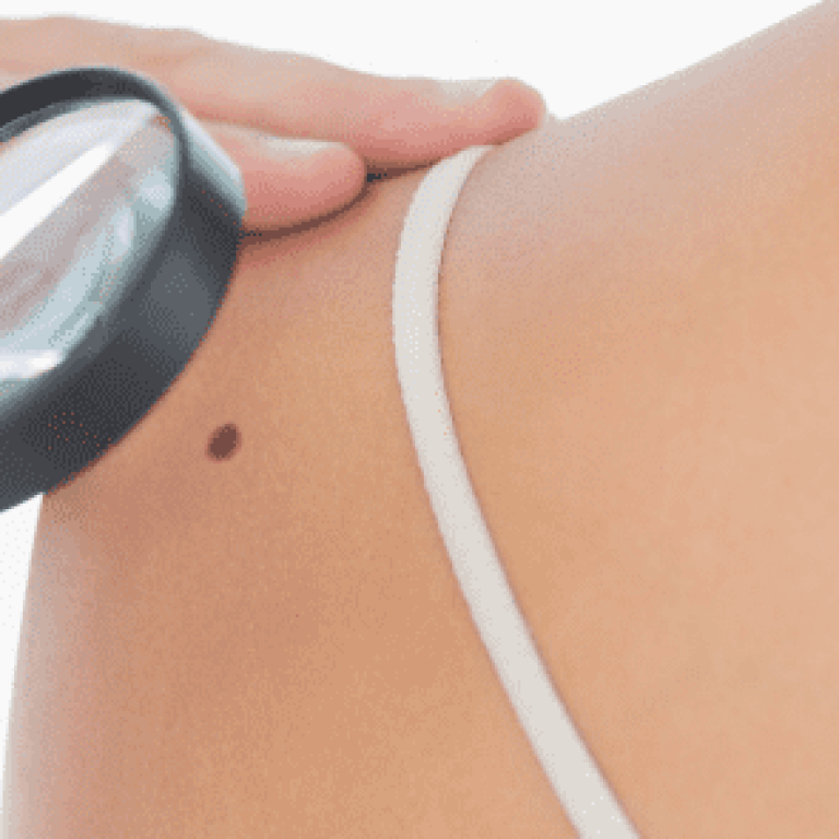 Doctor looking at mole on patient's shoulder with magnifying glass