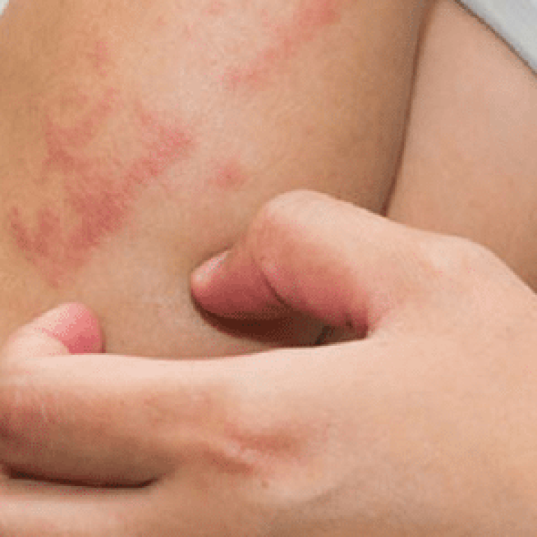 Person scratching psoriasis on their arm
