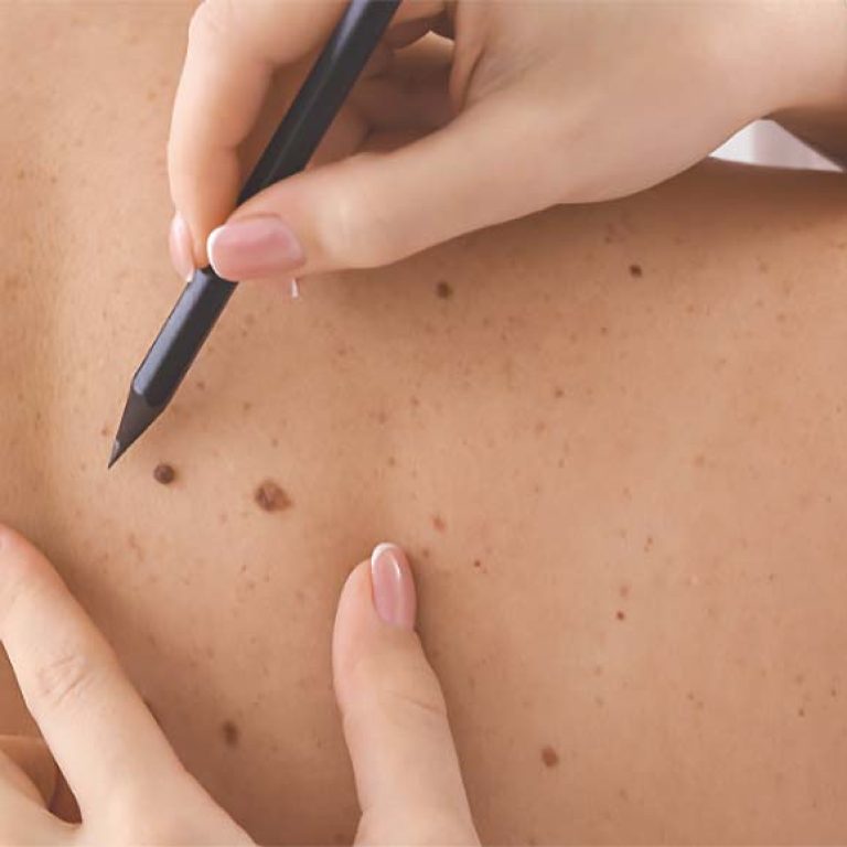 Image illustrating Why Annual Skin Checks Are Important