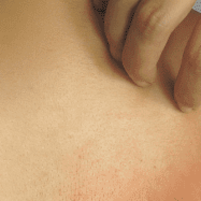 Woman scratching rash on her back