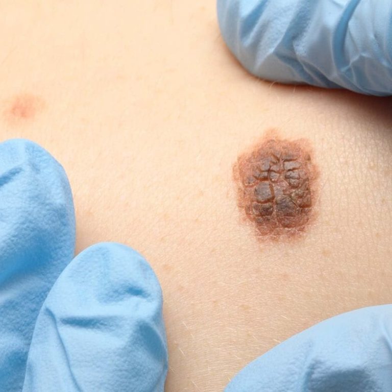 Doctor preparing for mohs surgery by examining spot on skin with gloved hands