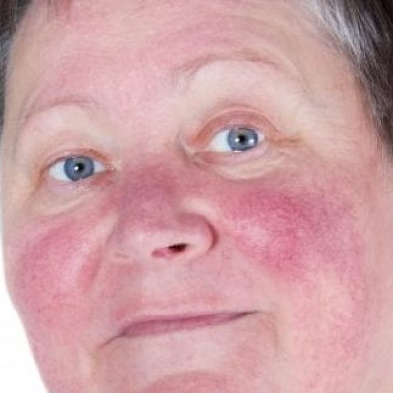 Person with rosacea on face