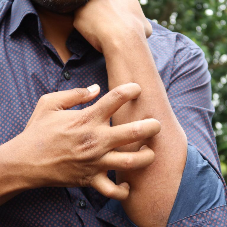 Man scratching his arm