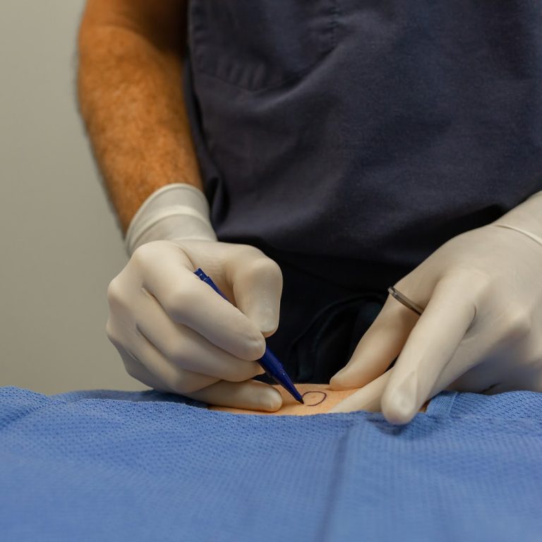 Dermatologist circling patient's skin in preparation for Mohs Surgery