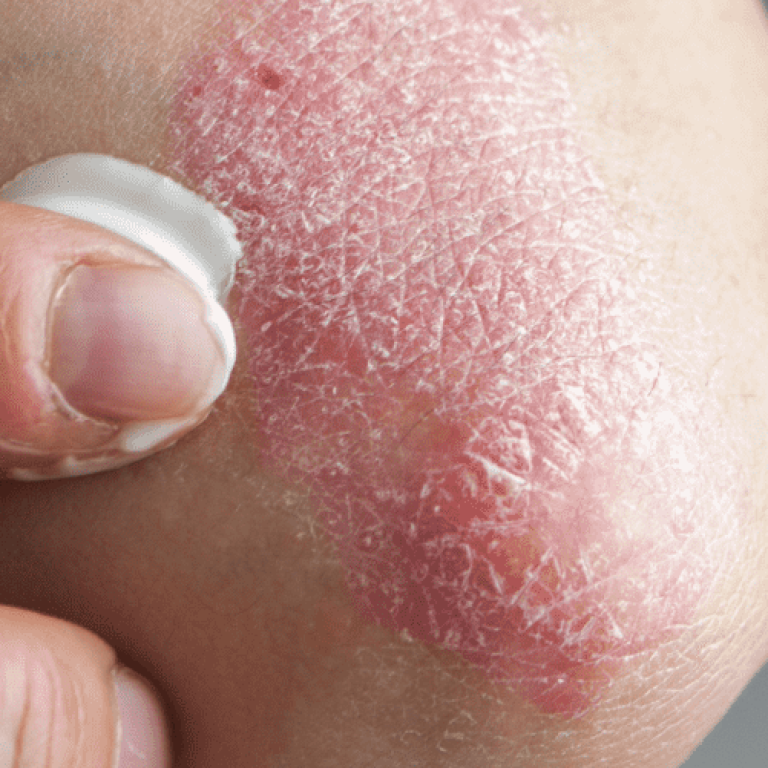 Putting cream on psoriasis on elbow