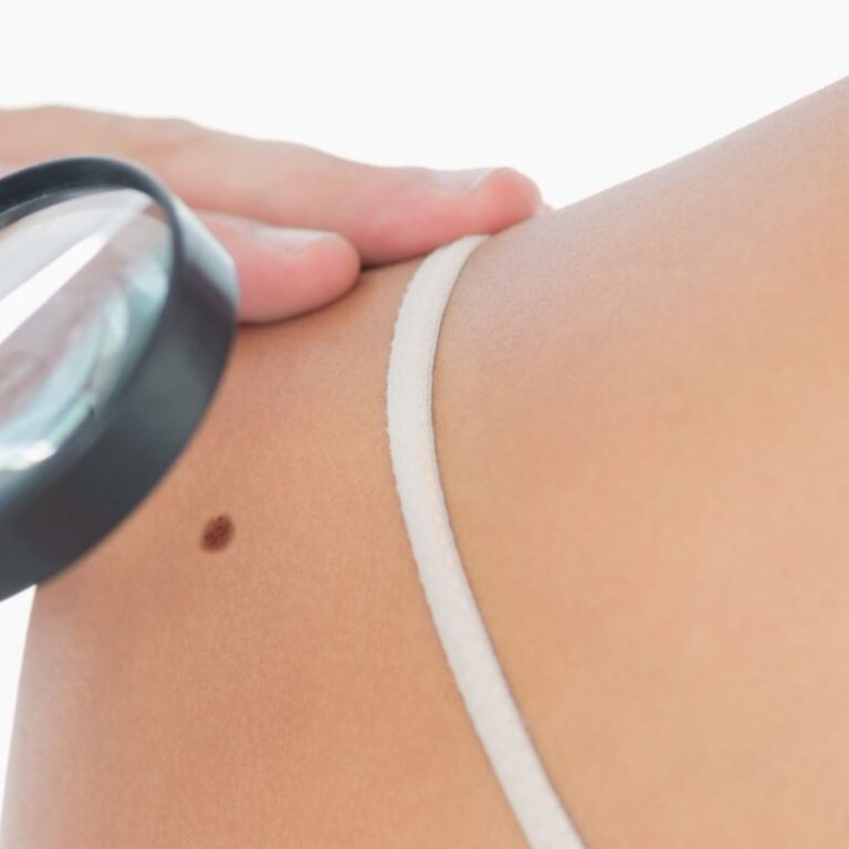 Doctor examining mole with magnifying glass