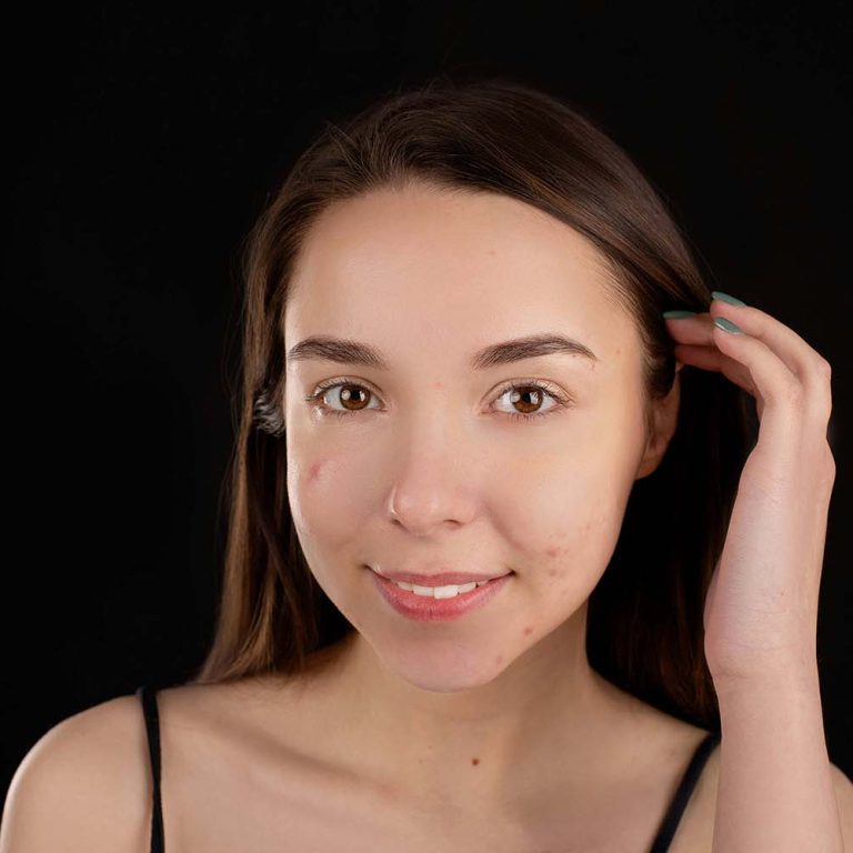 Image illustrating Stop Pushing Acne: How to Manage Breakouts Effectively