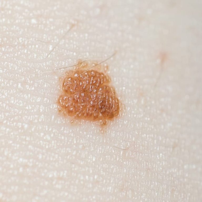 Sun damage spot on person's skin
