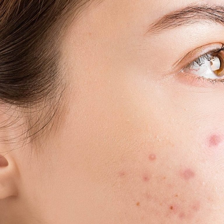 Close up of woman's face with acne on her cheek