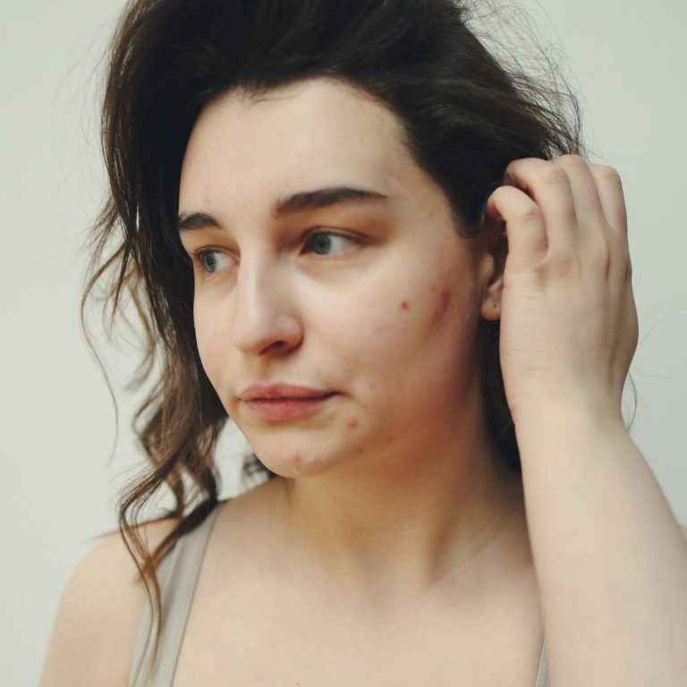 Woman with acne on her face tucking hair behind her ear