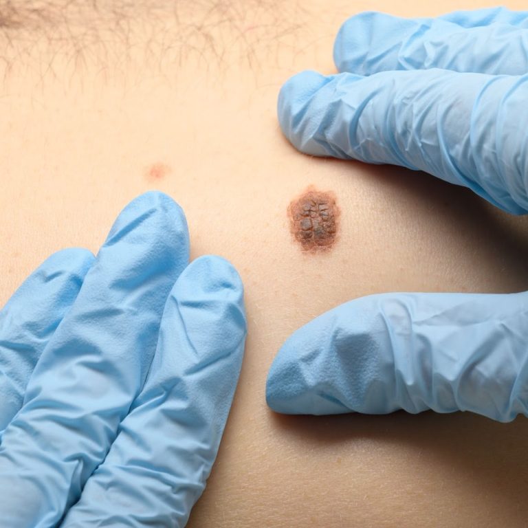 Close up of a doctor examining a mole on a patient
